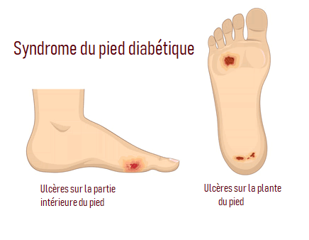 Mieux comprendre le pied du diabétique pour mieux vivre avec